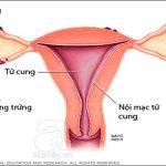 Lạc nội mạc tử cung là bệnh gì? Có nguy hiểm không?