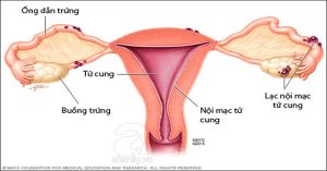 Lạc nội mạc tử cung là bệnh gì? Có nguy hiểm không?