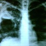 Lao phổi có di truyền?