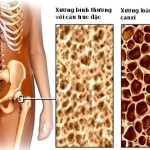Loãng xương – Căn bệnh âm thầm