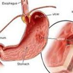 9 câu hỏi thường gặp về bệnh loét dạ dày
