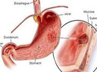 9 câu hỏi thường gặp về bệnh loét dạ dày