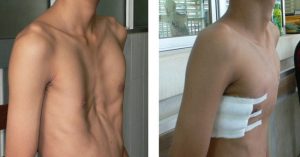 Lõm ngực bẩm sinh và những hệ lụy về sức khỏe