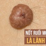 Lông mọc ở nốt ruồi không gây ung thư và có thể cắt bỏ được: Sự thật có phải vậy không?