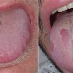 “Covid lưỡi”, triệu chứng mới của đại dịch