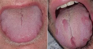 “Covid lưỡi”, triệu chứng mới của đại dịch