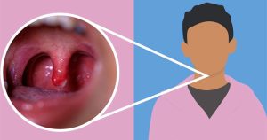 Lưỡi gà là gì? Lưỡi gà bị sưng là do đâu?