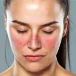 Lupus ban đỏ và vảy nến khác nhau như thế nào?