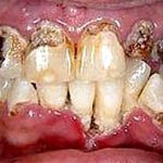 Càng uống nhiều nước ngọt, càng dễ hư men răng