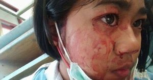 Mồ hôi máu là gì? Mồ hôi máu nguy hiểm thế nào? Mồ hôi máu có chữa được không?