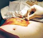 Hiệu quả điều trị chống tái nghiện Heroin bằng Abernil