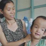 Não úng thủy ở trẻ em: Điều trị được nếu tận dụng “thời gian vàng”