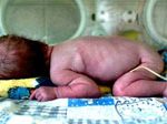 Em bé không miệng ra đời ở Ukraina