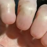“Dị nhân” tay không có móng, không dấu vân tay