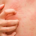 Nổi mề đay hậu Covid-19, chữa thế nào?