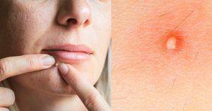 Cái gì đã tạo ra nốt mụn?