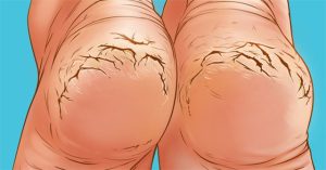 Vì sao nhiều người thường bị nứt gót chân?