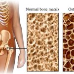 Phát hiện nhiều gene mới liên quan bệnh loãng xương