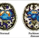 Thử nghiệm liệu pháp gien chữa bệnh Parkinson