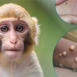Hướng dẫn cách phân biệt đậu mùa khỉ với thủy đậu, tay chân miệng và Herpes lan tỏa