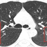 Hình ảnh phổi của bệnh nhân bị virus corona phá hủy