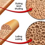Bác sĩ chuyên khoa đưa ra lời khuyên để giữ cho xương của bạn khỏe mạnh và phòng ngừa loãng xương