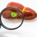 Bệnh polyp túi mật – Nguyên nhân, triệu chứng và cách điều trị