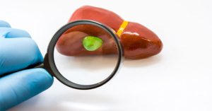 Bệnh polyp túi mật – Nguyên nhân, triệu chứng và cách điều trị