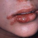 Các tổn thương mô mềm miệng ở trẻ em