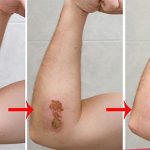 Da làm lành vết thương như thế nào?