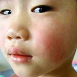 Mỹ: Bùng phát lây nhiễm bệnh quai bị