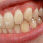 Răng của bạn có đốm trắng kỳ lạ này? Đây là lý do chúng xuất hiện