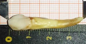Người đàn ông đi vào sách kỷ lục Guiness vì sở hữu chiếc răng dài gần 4cm