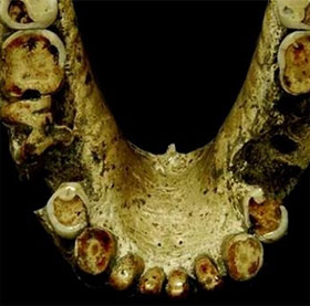 Bằng chứng cho thấy người cổ đại đã biết dùng tăm để “xỉa răng”