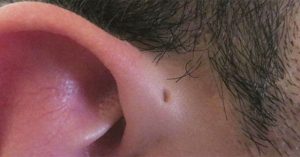 Rò luân nhĩ: Nguyên nhân, triệu chứng và cách điều trị