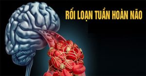 Bệnh rối loạn tuần hoàn não: Nguyên nhân, triệu chứng và cách điều trị