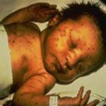 Thai phụ nhiễm Rubella có nguy cơ sinh quái thai