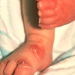 Bỏng da – Những điều cần biết