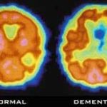 Scan não bộ có thể giúp chẩn đoán sớm bệnh Alzheimer