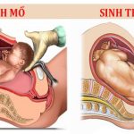2 mặt lợi – hại của sinh mổ so với sinh thường