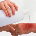 Sai lầm cần tránh khi sơ cứu nạn nhân bị dính axit