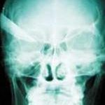 Cứu sống người bị đâm thủng não