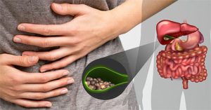 Sỏi mật: Nguyên nhân, triệu chứng và cách điều trị