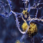Alzheimer cũng có nhiều loại khác nhau