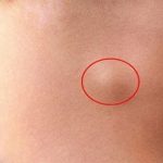 Sưng hạch bạch huyết là gì?