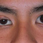 Căn bệnh chết người sau hiện tượng sụp mí mắt