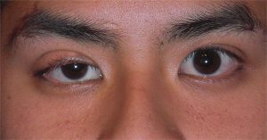Căn bệnh chết người sau hiện tượng sụp mí mắt