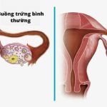 Suy buồng trứng nguyên phát là gì?