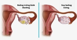 Suy buồng trứng nguyên phát là gì?