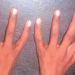 Hội chứng “tay người ngoài hành tinh” khiến ngón cái… biến thành ngón trỏ